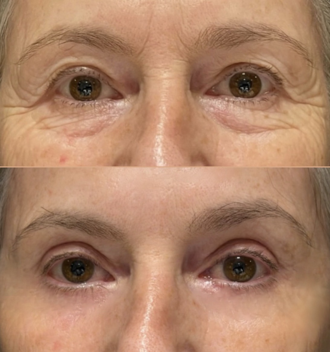 Blefaroplastia