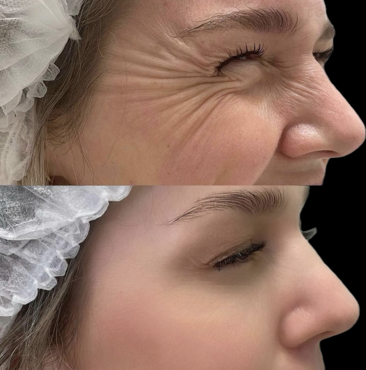 Botox Full Face