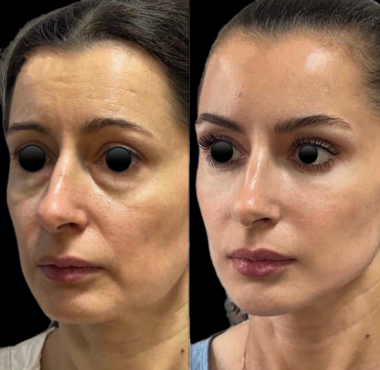 Lifting Facial – Ritidoplastia