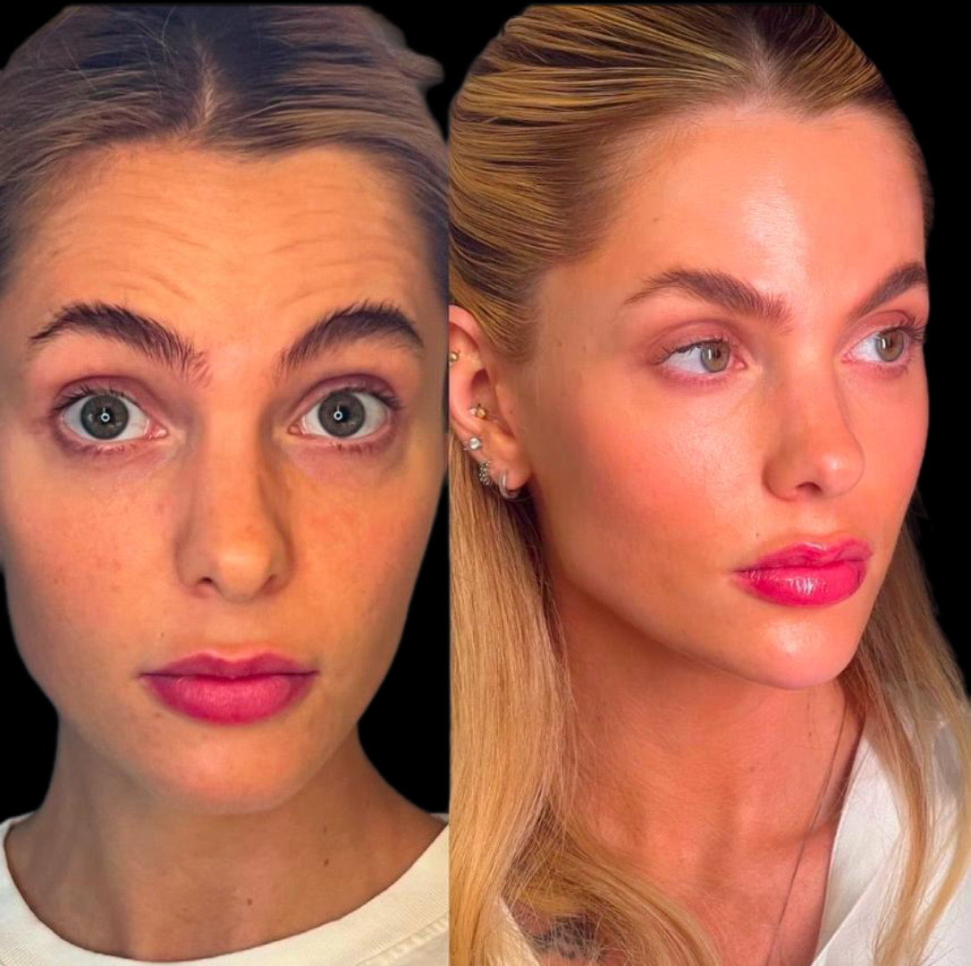 Face Up Lift®